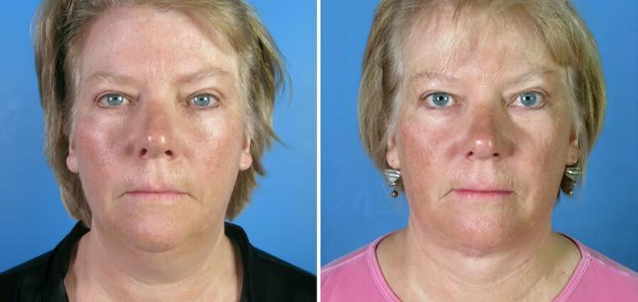 Before & After Facelift Case 17717 View #1 View in Alpharetta, GA