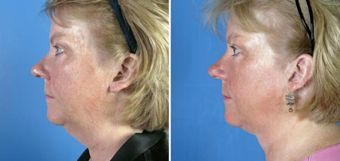 Before & After Facelift Case 17717 View #2 View in Alpharetta, GA