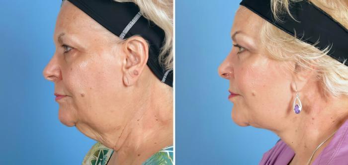 Before & After Facelift Case 17720 View #2 View in Alpharetta, GA