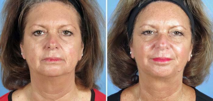 Before & After Facelift Case 17723 View #1 View in Alpharetta, GA