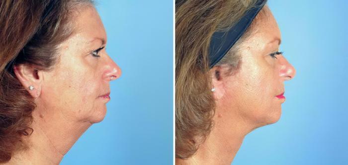Before & After Facelift Case 17723 View #2 View in Alpharetta, GA
