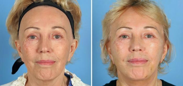 Before & After Facelift Case 17726 View #1 View in Alpharetta, GA