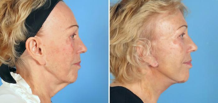Before & After Facelift Case 17726 View #2 View in Alpharetta, GA