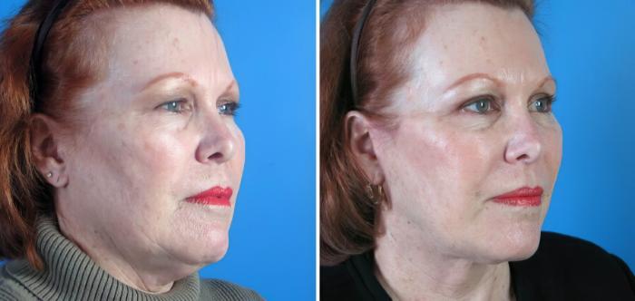 Before & After Facelift Case 17729 View #2 View in Alpharetta, GA