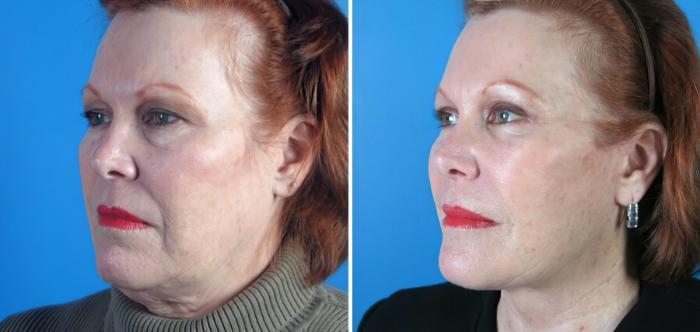 Before & After Facelift Case 17729 View #3 View in Alpharetta, GA