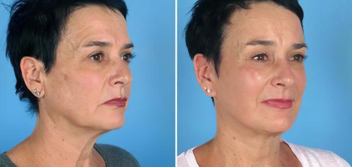 Before & After Facelift Case 19544 View #2 View in Alpharetta, GA