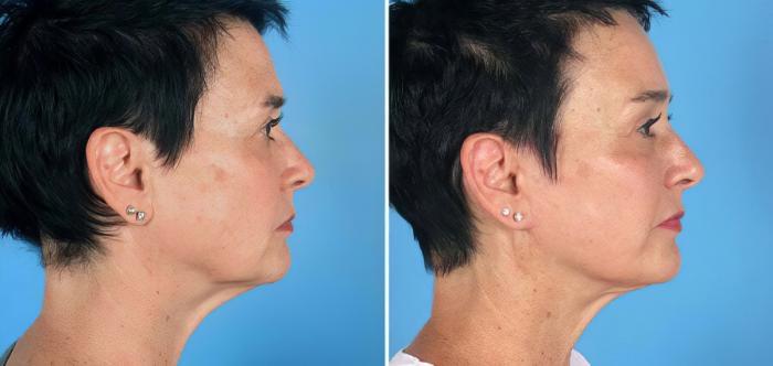 Before & After Facelift Case 19544 View #3 View in Alpharetta, GA
