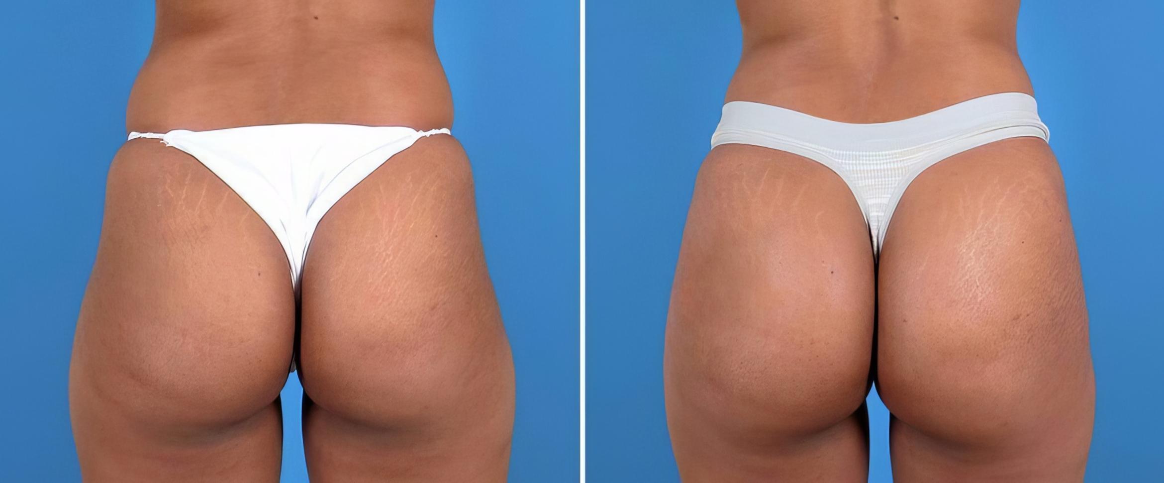 Before & After Injectable Butt Lift Case 25959 View #1 View in Alpharetta, GA