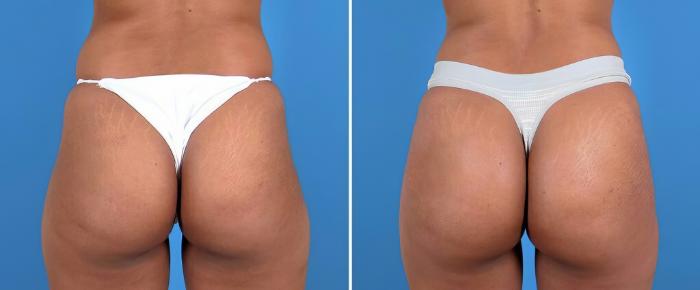 Before & After Injectable Butt Lift Case 25959 View #1 View in Alpharetta, GA