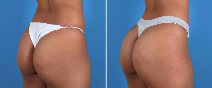 Before & After Injectable Butt Lift Case 25959 View #2 View in Alpharetta, GA