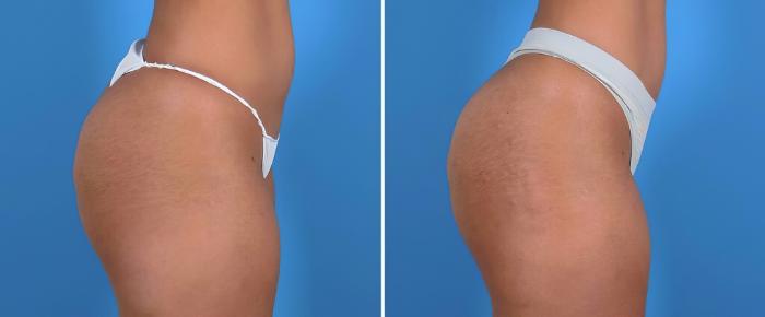 Before & After Injectable Butt Lift Case 25959 View #3 View in Alpharetta, GA