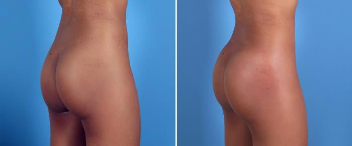 Before & After Injectable Butt Lift Case 26156 View #1 View in Alpharetta, GA
