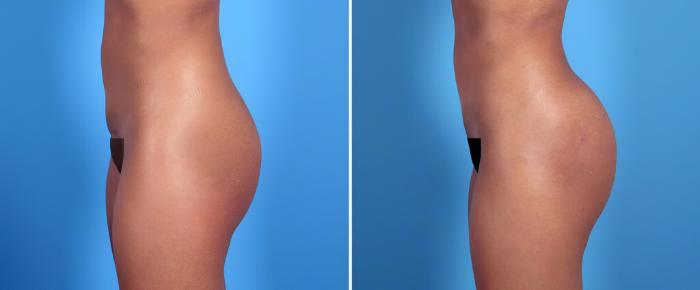 Before & After Injectable Butt Lift Case 26156 View #2 View in Alpharetta, GA