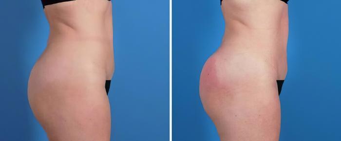 Before & After Injectable Butt Lift Case 26496 View #1 View in Alpharetta, GA