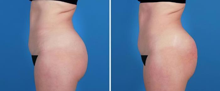 Before & After Injectable Butt Lift Case 26496 View #2 View in Alpharetta, GA