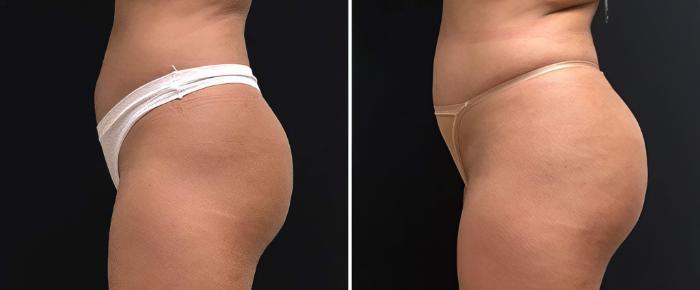Before & After Injectable Butt Lift Case 26833 View #1 View in Alpharetta, GA