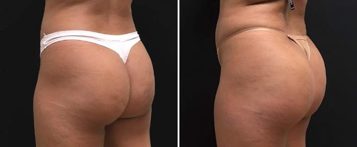 Before & After Injectable Butt Lift Case 26833 View #2 View in Alpharetta, GA