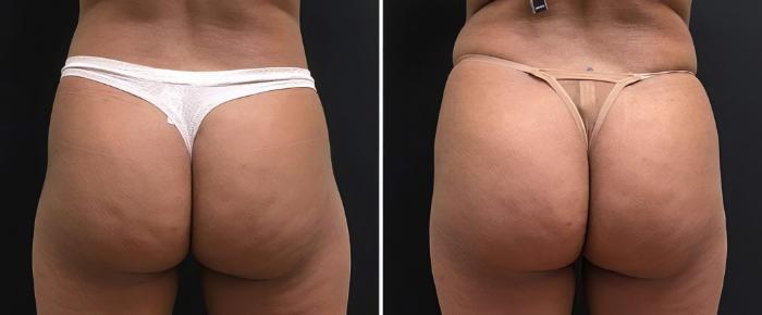 Before & After Injectable Butt Lift Case 26833 View #3 View in Alpharetta, GA