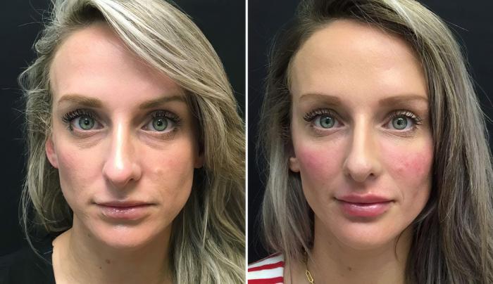 Before & After Injectables & Fillers Case 26623 View #1 View in Alpharetta, GA