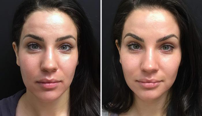 Before & After Injectables & Fillers Case 26626 View #1 View in Alpharetta, GA