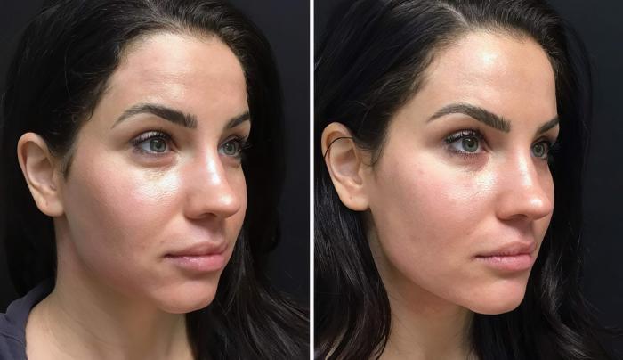 Before & After Injectables & Fillers Case 26626 View #2 View in Alpharetta, GA
