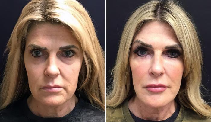 Before & After Injectables & Fillers Case 26630 View #1 View in Alpharetta, GA