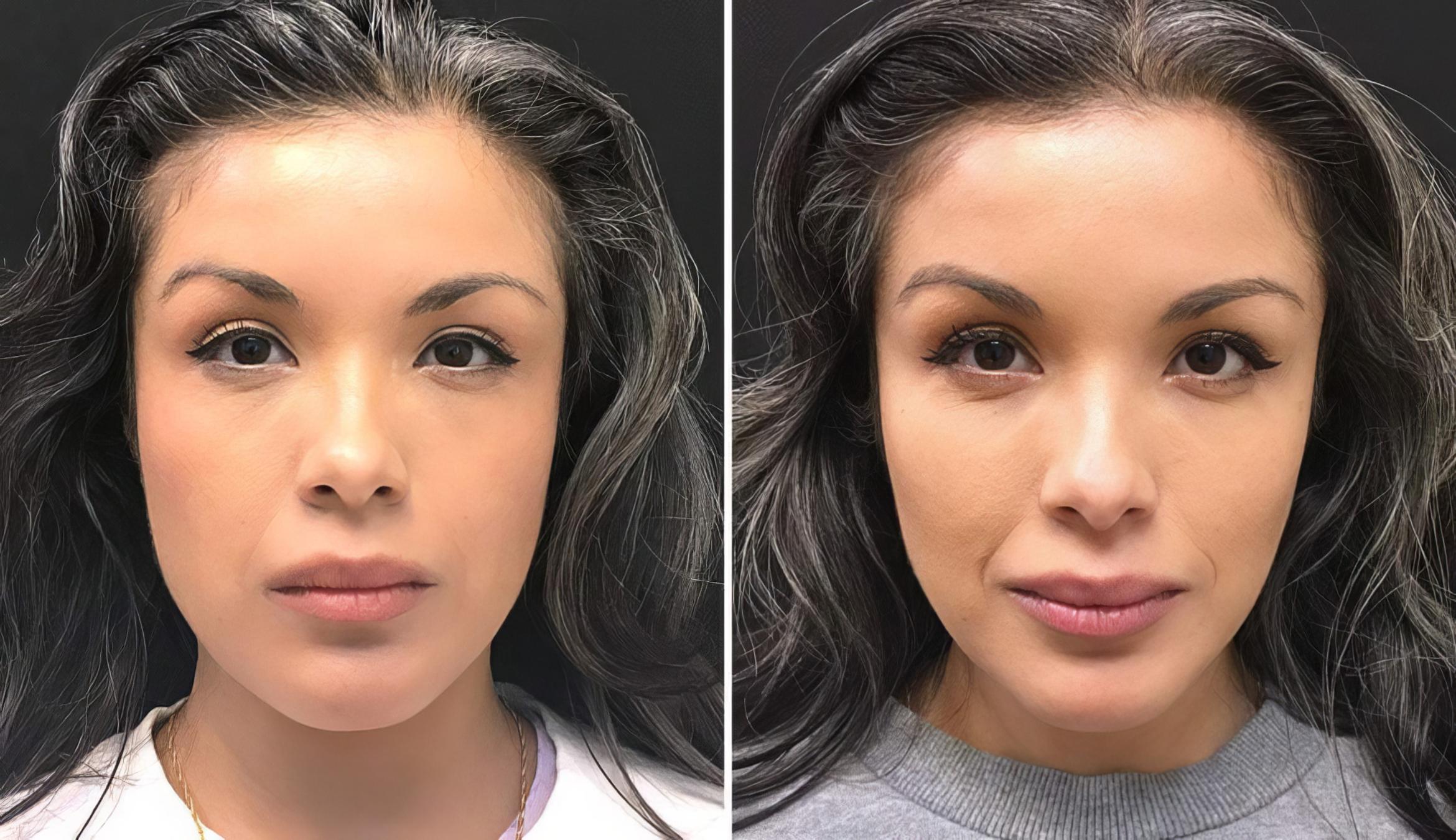 Before & After Injectables & Fillers Case 26633 View #1 View in Alpharetta, GA
