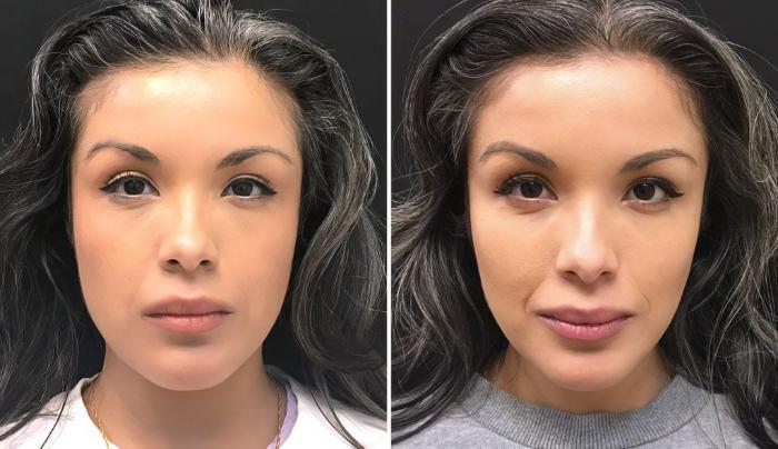 Before & After Injectables & Fillers Case 26633 View #1 View in Alpharetta, GA