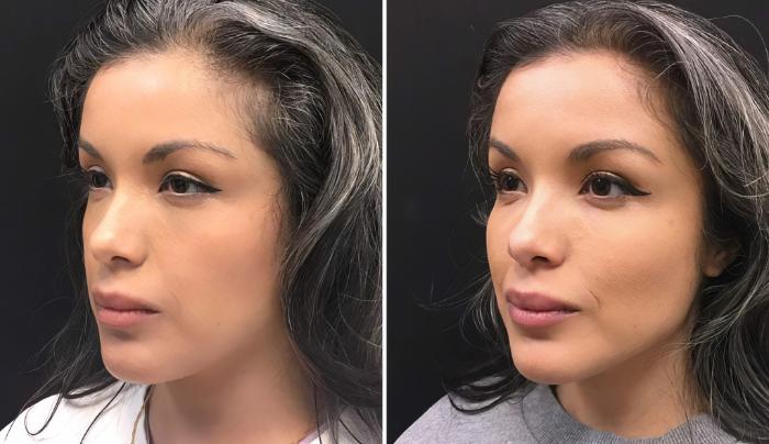 Before & After Injectables & Fillers Case 26633 View #2 View in Alpharetta, GA