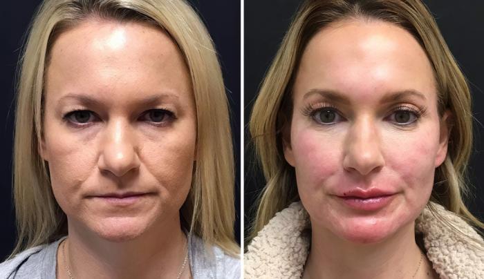 Before & After Injectables & Fillers Case 26636 View #1 View in Alpharetta, GA