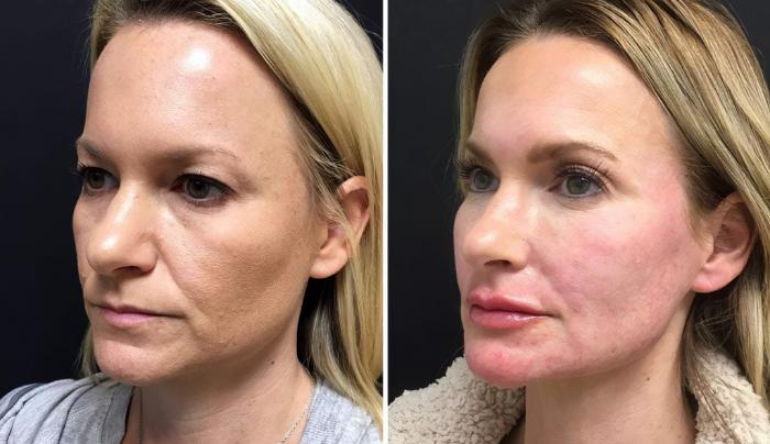 Before & After Injectables & Fillers Case 26636 View #2 View in Alpharetta, GA