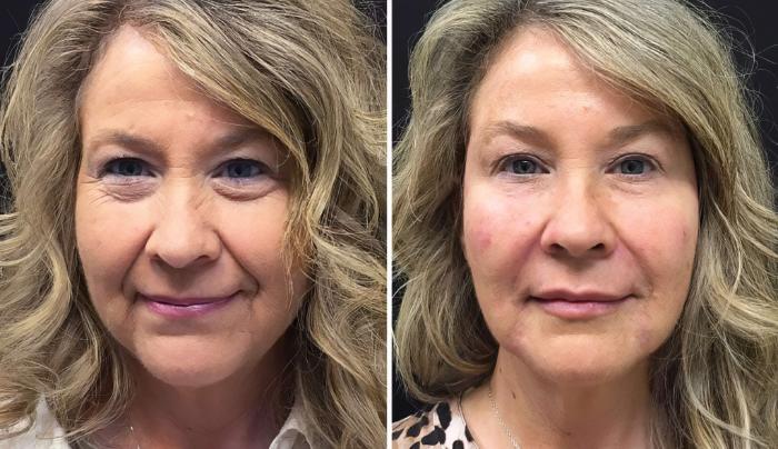 Before & After Injectables & Fillers Case 26642 View #1 View in Alpharetta, GA