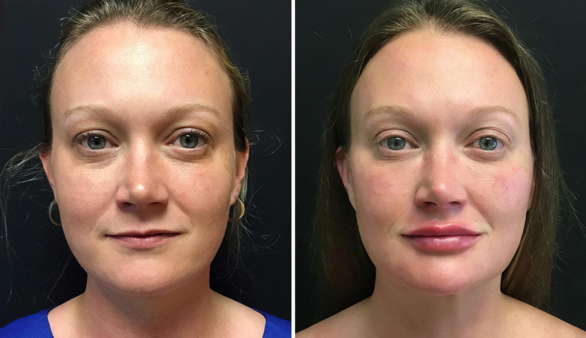 Before & After Injectables & Fillers Case 26647 View #1 View in Alpharetta, GA
