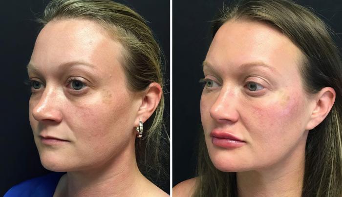 Before & After Injectables & Fillers Case 26647 View #2 View in Alpharetta, GA