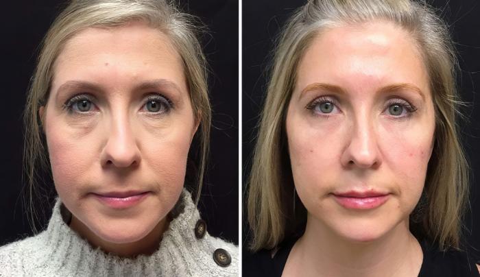 Before & After Injectables & Fillers Case 26650 View #1 View in Alpharetta, GA