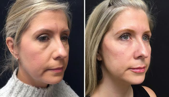Before & After Injectables & Fillers Case 26650 View #2 View in Alpharetta, GA