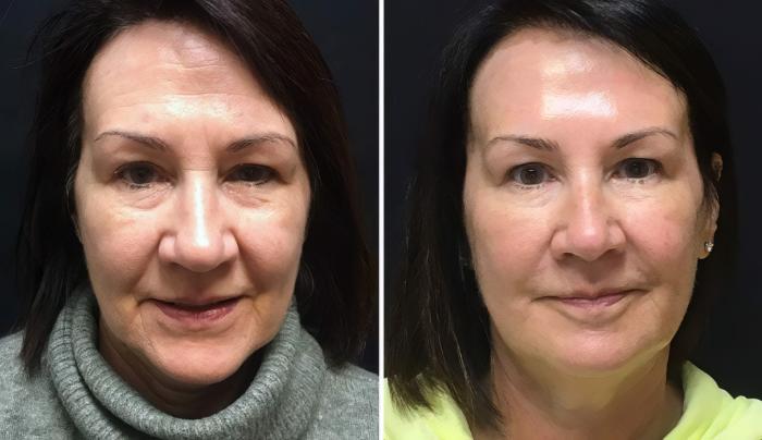 Before & After Injectables & Fillers Case 26653 View #1 View in Alpharetta, GA