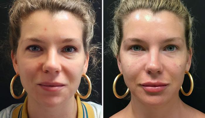 Before & After Injectables & Fillers Case 26665 View #1 View in Alpharetta, GA