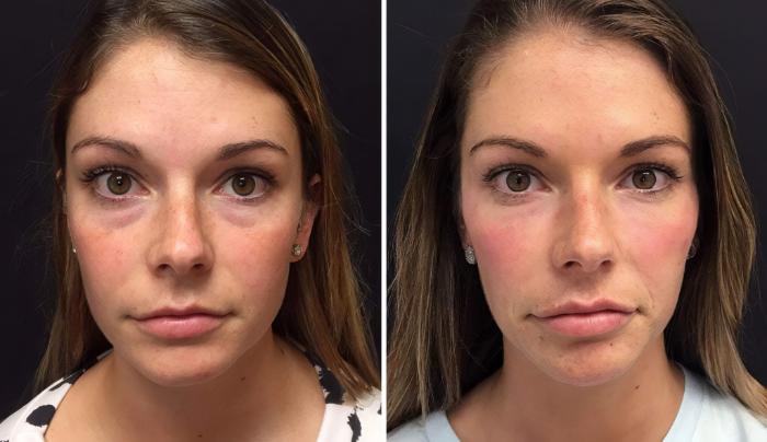 Before & After Injectables & Fillers Case 26668 View #1 View in Alpharetta, GA