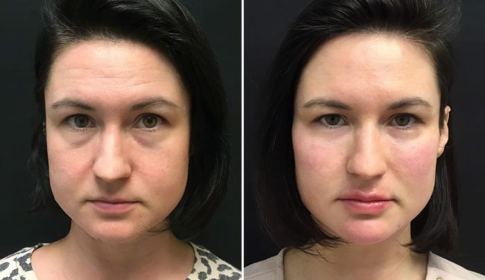 Before & After Injectables & Fillers Case 26673 View #1 View in Alpharetta, GA