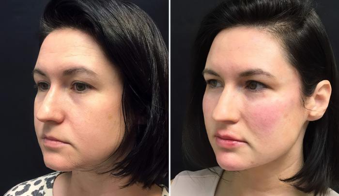 Before & After Injectables & Fillers Case 26673 View #2 View in Alpharetta, GA