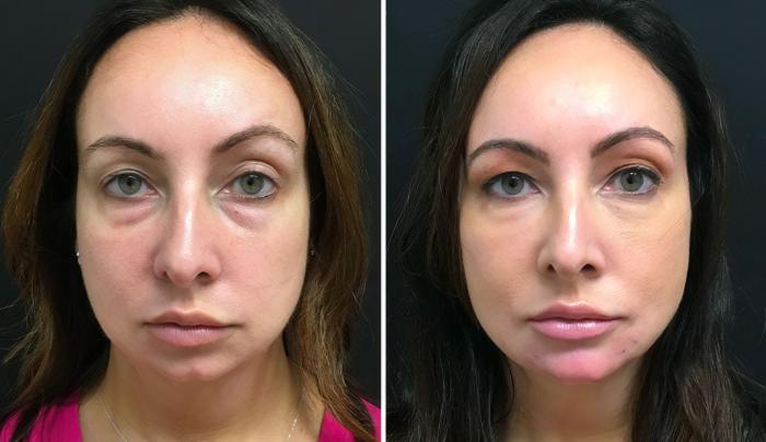 Before & After Injectables & Fillers Case 26685 View #1 View in Alpharetta, GA