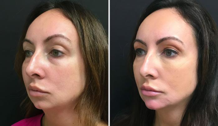 Before & After Injectables & Fillers Case 26685 View #2 View in Alpharetta, GA
