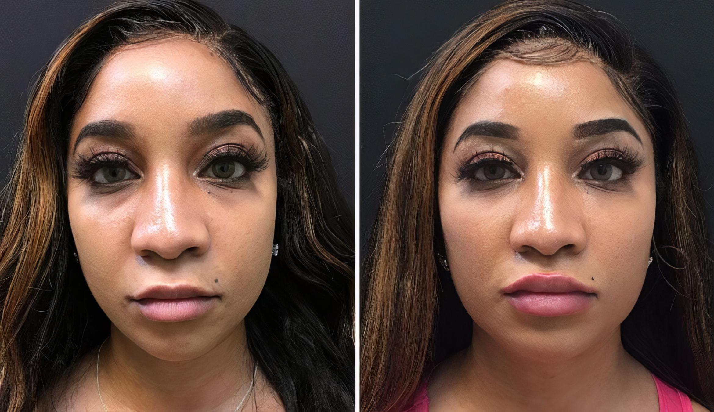 Before & After Injectables & Fillers Case 26784 View #1 View in Alpharetta, GA