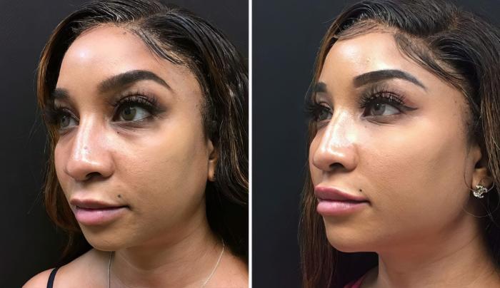 Before & After Injectables & Fillers Case 26784 View #3 View in Alpharetta, GA
