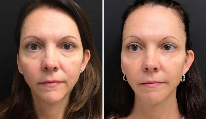 Before & After Injectables & Fillers Case 28302 View #1 View in Alpharetta, GA