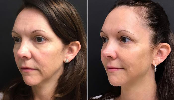 Before & After Injectables & Fillers Case 28302 View #2 View in Alpharetta, GA
