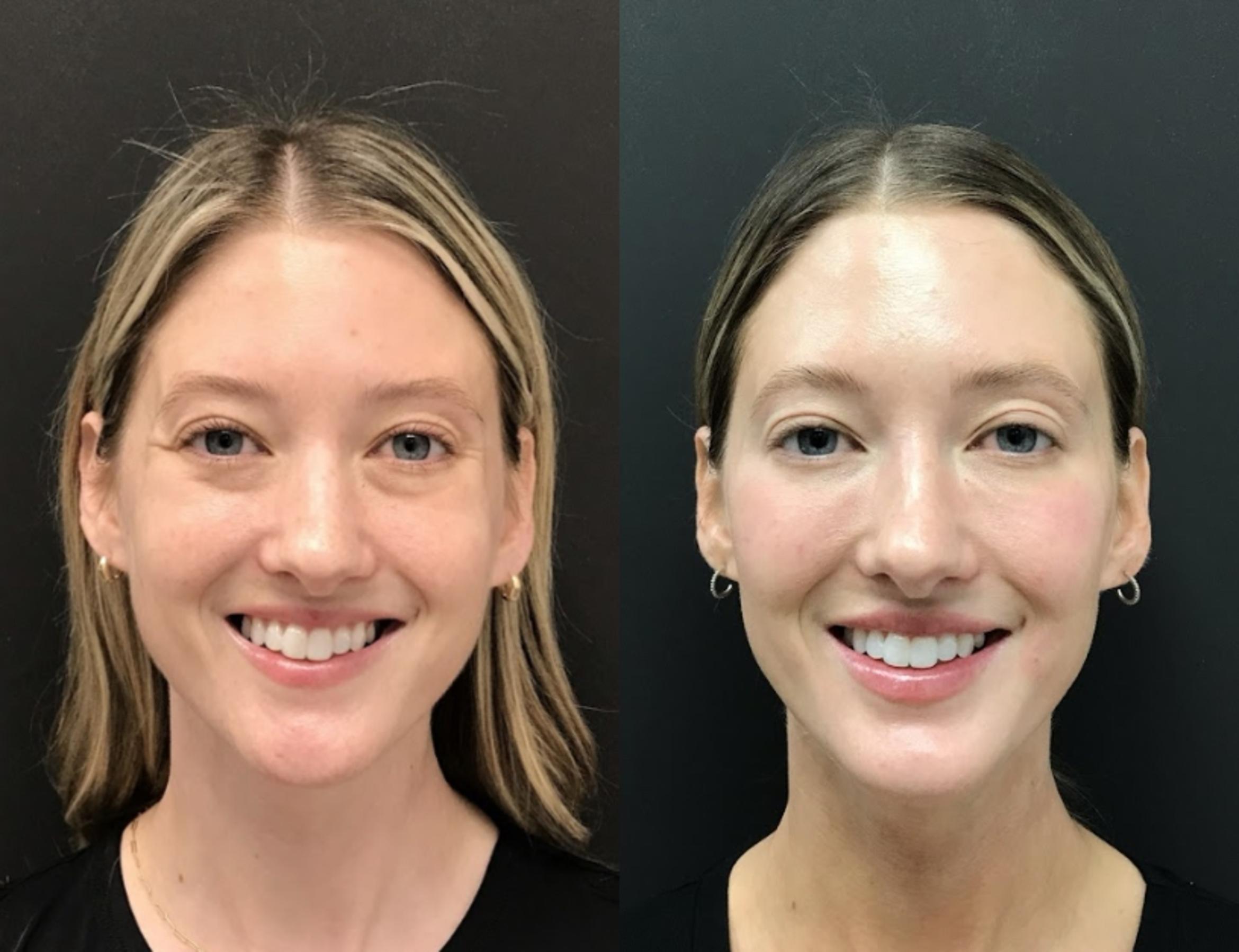 Before & After Injectables & Fillers Case 28317 Front View in Atlanta, GA