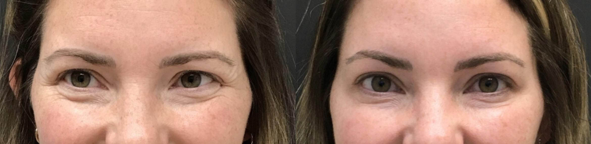 Before & After Injectables & Fillers Case 28318 Front View in Atlanta, GA