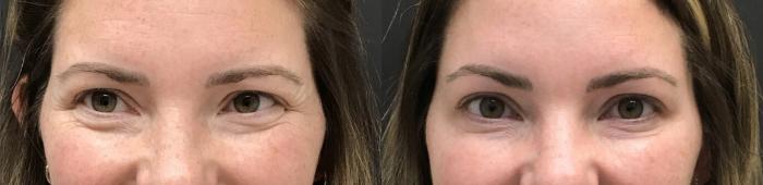 Before & After Injectables & Fillers Case 28318 Front View in Atlanta, GA